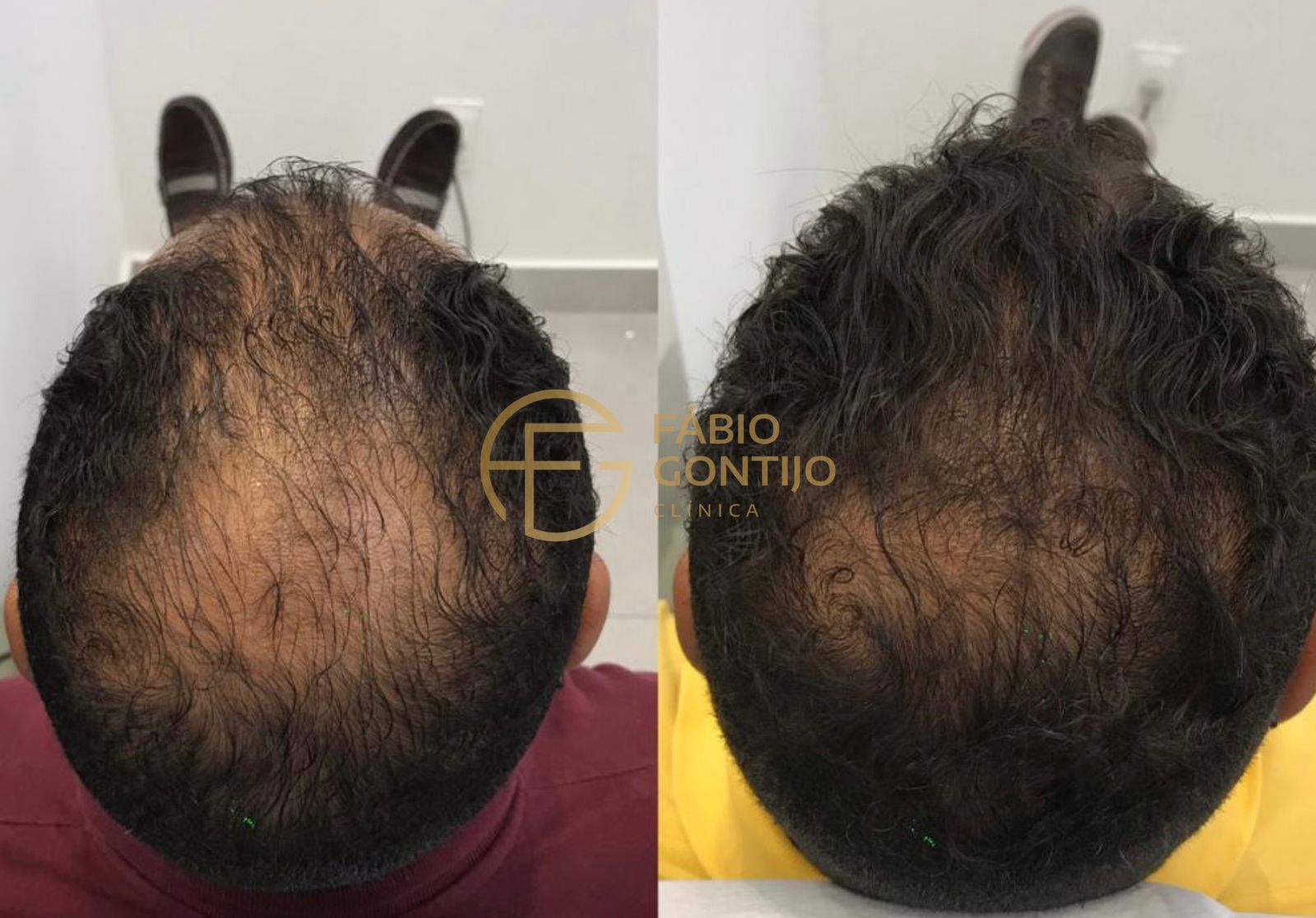 Antes e depois de tratamento capilar, vista superior