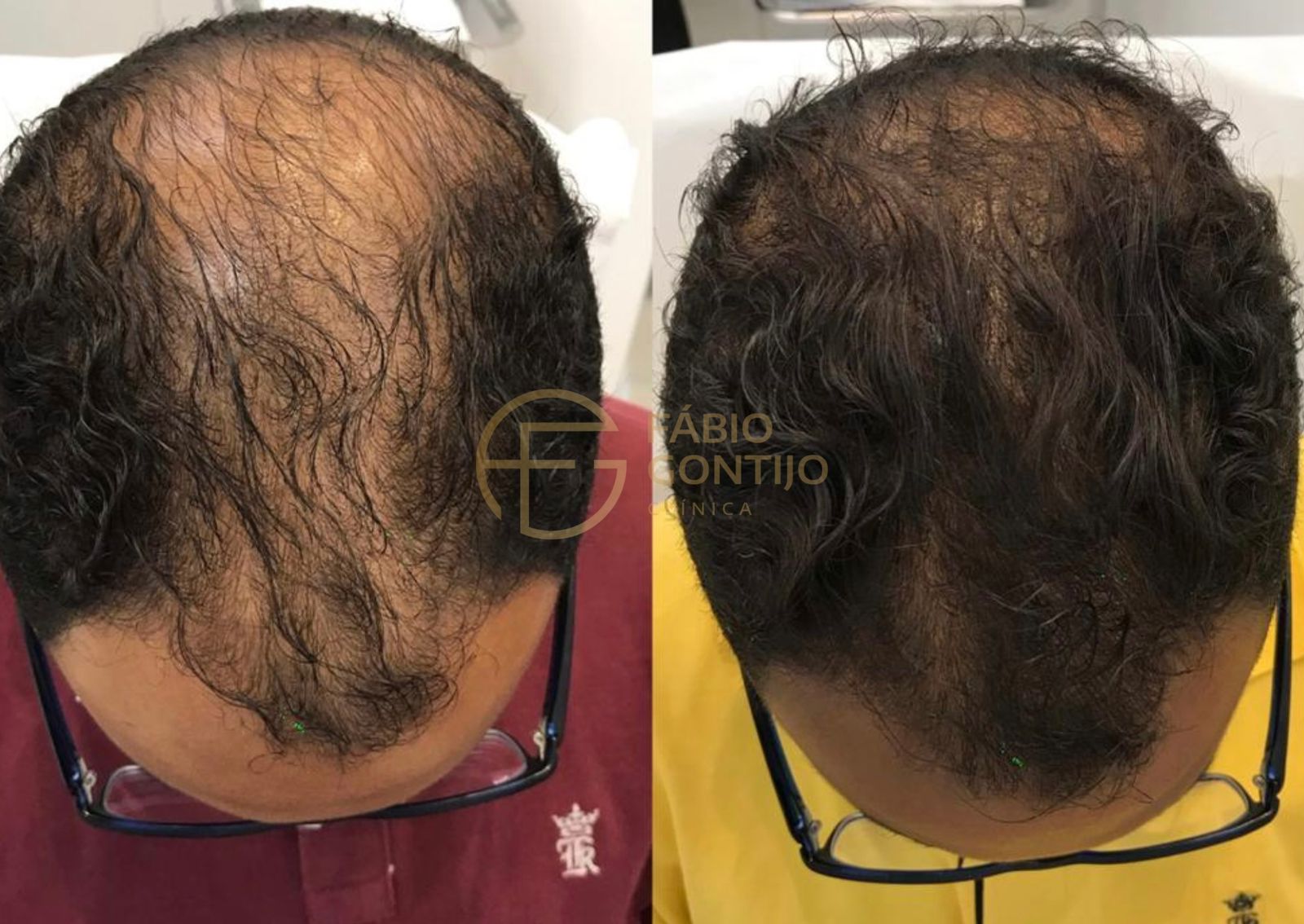 Antes e depois de tratamento capilar, região frontal