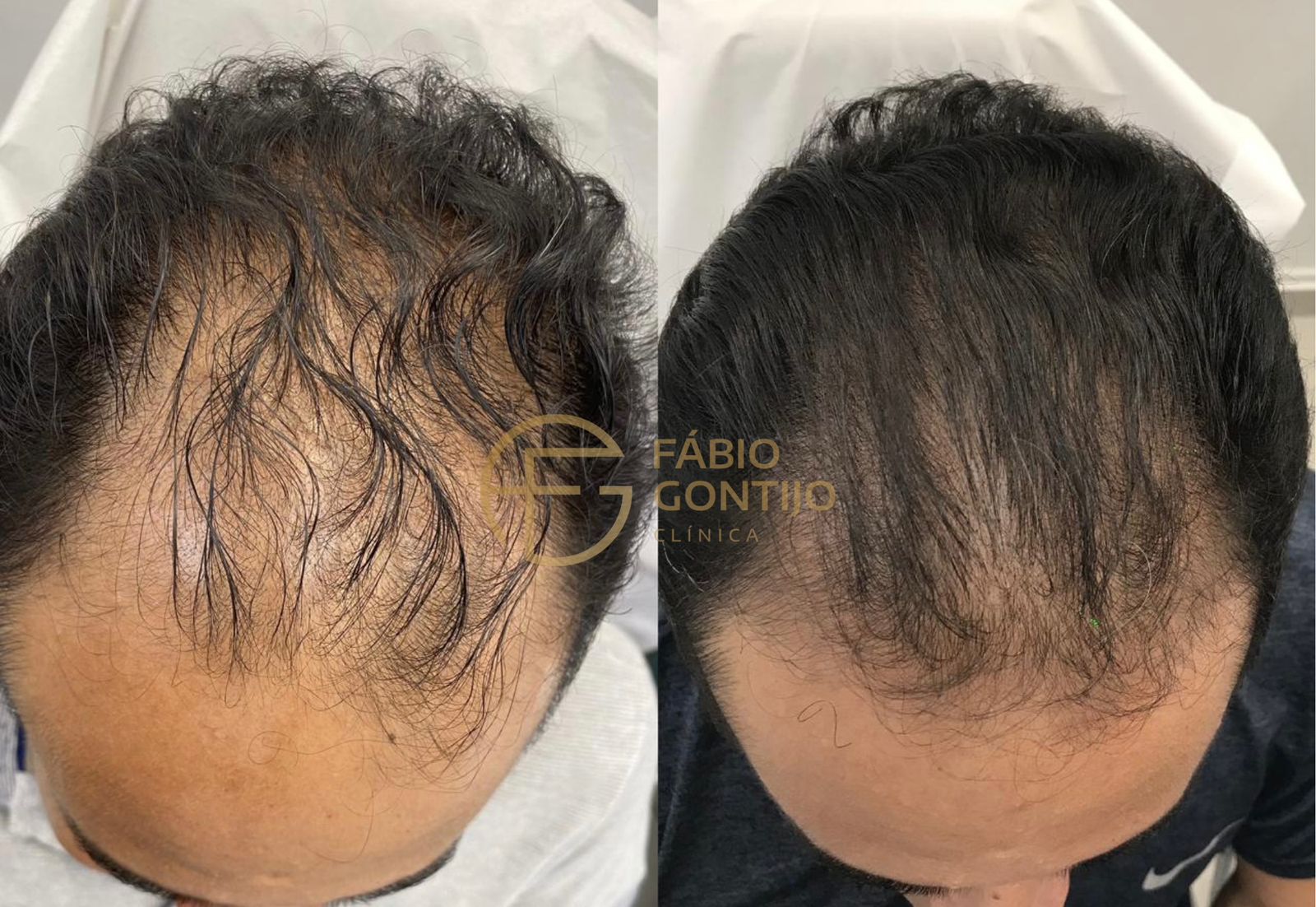 Antes e depois de tratamento capilar, linha frontal